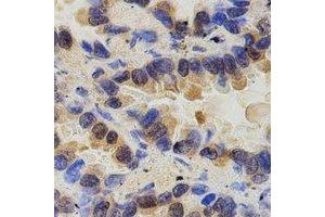Immunohistochemical analysis of PAK2 staining in human lung cancer formalin fixed paraffin embedded tissue section. (PAK2 antibody)