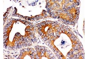 IHC-P: Integrin alpha 1 antibody testing of human intestinal cancer tissue (Integrin alpha 1 antibody  (C-Term))