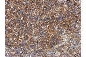 IHC-P Image Immunohistochemical analysis of paraffin-embedded human hepatoma, using GS2, antibody at 1:500 dilution. (PNPLA4 antibody)