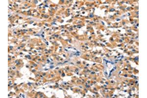 The image on the left is immunohistochemistry of paraffin-embedded Human thyroid cancer tissue using ABIN7190518(DUSP2 Antibody) at dilution 1/30, on the right is treated with synthetic peptide. (DUSP2 antibody)