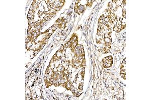 Immunohistochemistry of paraffin-embedded human lung cancer using UQCRH Rabbit mAb (ABIN7271126) at dilution of 1:50 (40x lens). (UQCRH antibody)