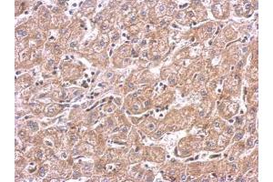 IHC-P Image mTOR antibody detects FRAP1 protein at cytosol on human hepatoma by immunohistochemical analysis.