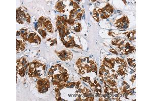 Immunohistochemistry of Human thyroid cancer using HINT2 Polyclonal Antibody at dilution of 1:50