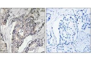 Immunohistochemistry analysis of paraffin-embedded human breast carcinoma, using THBS4 Antibody. (THBS4 antibody  (AA 561-610))
