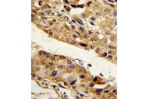 Formalin-fixed and paraffin-embedded human hepatocarcinoma reacted with SERPINF1 Antibody (N-term), which was peroxidase-conjugated to the secondary antibody, followed by DAB staining. (PEDF antibody  (N-Term))