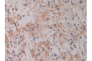 Detection of Hepc in Human Glioma Tissue using Monoclonal Antibody to Hepcidin (Hepc) (Hepcidin antibody  (AA 25-84))