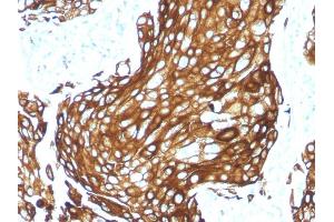 Formalin-fixed, paraffin-embedded human Lung Carcinoma stained with CK LMW Rabbit Recombinant Monoclonal Antibody (KRTL/1577R). (Recombinant Keratin 77 antibody)