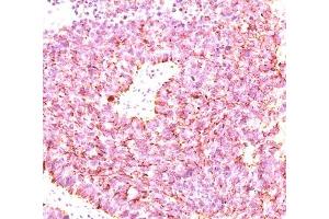 IHC testing of human small cell lung carcinoma stained with chromogranin A antibody cocktail (clones LK2H10 + PHE5 + CGA414). (Chromogranin A antibody)