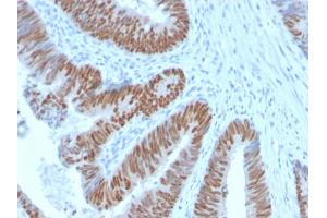 Formalin-fixed, paraffin-embedded human Colon Carcinoma stained with CDX2 Rabbit Recombinant Monoclonal Antibody (CDX2/2951R). (Recombinant CDX2 antibody  (AA 150-249))