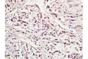 Formalin-fixed and paraffin embedded human lung carcinoma labeled with Rabbit Anti-SIRT1(Ser47) Polyclonal Antibody, Unconjugated 1:200 followed by conjugation to the secondary antibody and DAB staining (SIRT1 antibody  (pSer47))