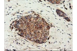 Immunohistochemical staining of paraffin-embedded Adenocarcinoma of Human breast tissue using anti-CLPP mouse monoclonal antibody. (CLPP antibody)