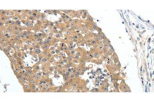 Immunohistochemistry of paraffin-embedded Human breast cancer tissue using FSHR Polyclonal Antibody at dilution 1:70 (FSHR antibody)