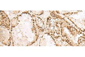 Immunohistochemistry of paraffin-embedded Human thyroid cancer tissue using KRR1 Polyclonal Antibody at dilution of 1:50(x200) (KRR1 antibody)