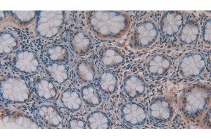 Immunohistochemistry (IHC) image for anti-Matrix Metallopeptidase 11 (Stromelysin 3) (MMP11) (AA 277-488) antibody (ABIN7431380)