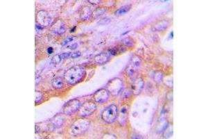 Immunohistochemical analysis of FOXO1 staining in human lung cancer formalin fixed paraffin embedded tissue section.