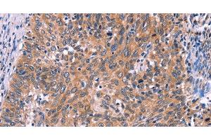 Immunohistochemistry of paraffin-embedded Human cervical cancer tissue using EDN1 Polyclonal Antibody at dilution 1:50 (Endothelin 1 antibody)