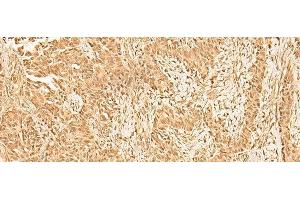 Immunohistochemistry of paraffin-embedded Human ovarian cancer tissue using ZNF471 Polyclonal Antibody at dilution of 1:50(x200) (ZNF471 antibody)
