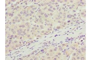 Immunohistochemistry of paraffin-embedded human liver cancer using ABIN7166405 at dilution of 1:100 (ARMT1 (AA 2-250) antibody)