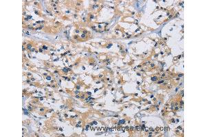 Immunohistochemistry of Human thyroid cancer using IL17RB Polyclonal Antibody at dilution of 1:40 (IL17 Receptor B antibody)