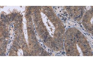 Immunohistochemistry of paraffin-embedded Human colon cancer using CDK5 Polyclonal Antibody at dilution of 1:30 (CDK5 antibody)