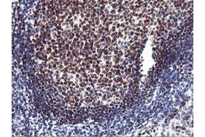 Immunohistochemical staining of paraffin-embedded Human lymphoma tissue using anti-MEF2C mouse monoclonal antibody. (MEF2C antibody)