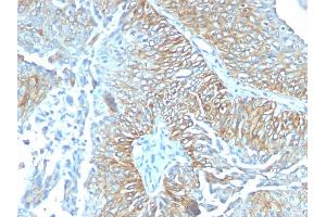 Formalin-fixed, paraffin-embedded human Esophageal carcinoma stained with TRIM29 Mouse Monoclonal Antibody (TRIM29/1041). (TRIM29 antibody  (AA 1-200))