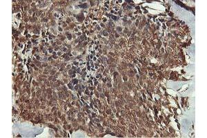 Immunohistochemical staining of paraffin-embedded Adenocarcinoma of Human breast tissue using anti-AKT1 mouse monoclonal antibody. (AKT1 antibody)