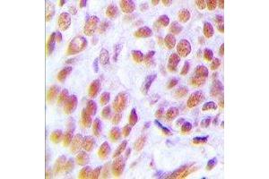 Immunohistochemical analysis of ZNF265 staining in human breast cancer formalin fixed paraffin embedded tissue section. (ZNF265 antibody)