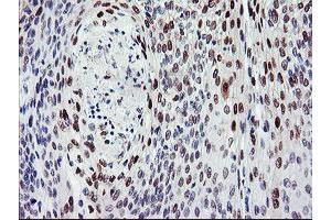 Immunohistochemical staining of paraffin-embedded Carcinoma of Human bladder tissue using anti-BACH1 mouse monoclonal antibody. (BACH1 antibody)
