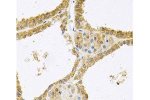 Immunohistochemistry of paraffin-embedded Human thyroid cancer using FHL1 Polyclonal Antibody at dilution of 1:100 (40x lens). (FHL1 antibody)