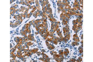 Immunohistochemistry of Human thyroid cancer using NCR3 Polyclonal Antibody at dilution of 1:40