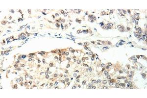 Immunohistochemistry of paraffin-embedded Human breast cancer using TPM2 Polyclonal Antibody at dilution of 1:60 (TPM2 antibody)