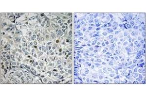 Immunohistochemistry analysis of paraffin-embedded human breast carcinoma, using USP53 Antibody. (USP53 antibody  (AA 951-1000))