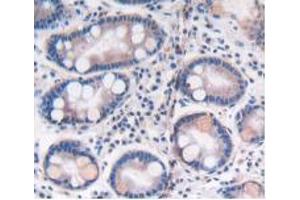 IHC-P analysis of Human Stomach Cancer Tissue, with DAB staining. (ATP6AP2 antibody  (AA 17-302))