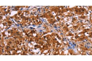 Immunohistochemistry of paraffin-embedded Human thyroid cancer tissue using USP2 Polyclonal Antibody at dilution 1:40 (USP2 antibody)