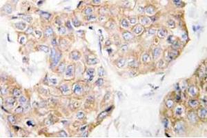 Immunohistochemistry analysis of CD213a1 / IL13RA1 Antibody in paraffin-embedded human breast carcinoma tissue.