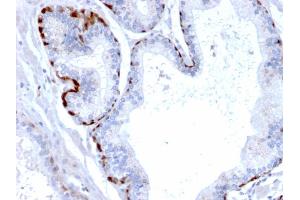 Formalin-fixed, paraffin-embedded human Prostate Carcinoma stained with Cystatin A Mouse Monoclonal Antibody (CPTC-CSTA-1). (CSTA antibody)