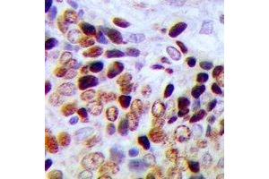 Immunohistochemical analysis of CBP20 staining in human prostate cancer formalin fixed paraffin embedded tissue section. (NCBP2 antibody  (N-Term))