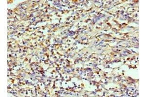 Immunohistochemistry of paraffin-embedded human cervical cancer using ABIN7143994 at dilution of 1:100 (AIMP1 antibody  (AA 25-180))
