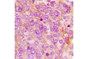 Immunohistochemical analysis of MDA5 staining in human breast cancer formalin fixed paraffin embedded tissue section. (IFIH1 antibody  (C-Term))