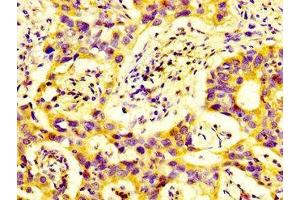 IHC image of ABIN7150786 diluted at 1:600 and staining in paraffin-embedded human bladder cancer performed on a Leica BondTM system. (DUSP9 antibody  (AA 142-263))