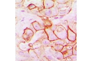 Immunohistochemical analysis of PMEPA1 staining in human breast cancer formalin fixed paraffin embedded tissue section.