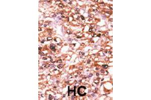 Formalin-fixed and paraffin-embedded human hepatocellular carcinoma tissue reacted with ACVR2B polyclonal antibody  , which was peroxidase-conjugated to the secondary antibody, followed by AEC staining. (ACVR2B antibody  (N-Term))