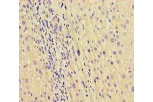 Immunohistochemistry of paraffin-embedded human liver cancer using ABIN7168865 at dilution of 1:100 (Septin 2 antibody  (AA 1-361))