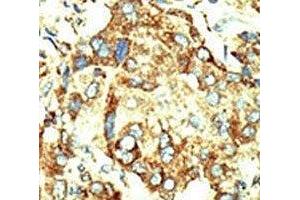 IHC analysis of FFPE human hepatocarcinoma stained with the Dnmt2 antibody (Dnmt2 antibody  (AA 346-375))