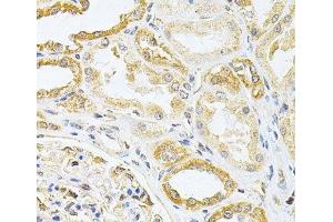 Immunohistochemistry of paraffin-embedded Human kidney cancer using VAPB Polyclonal Antibody at dilution of 1:200 (40x lens).
