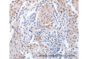 Immunohistochemistry of Human lung cancer using APEX1 Polyclonal Antibody at dilution of 1:20