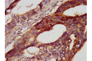 IHC image of ABIN7146237 diluted at 1:400 and staining in paraffin-embedded human colon cancer performed on a Leica BondTM system. (Cadherin 7 antibody  (AA 146-296))