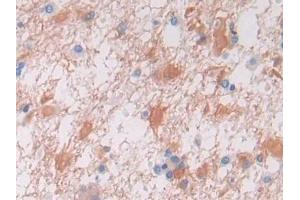 DAB staining on IHC-P; Samples: Human Glioma Tissue (VWA3A antibody  (AA 981-1176))