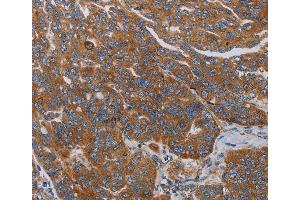 Immunohistochemistry of Human cervical cancer using PARP10 Polyclonal Antibody at dilution of 1:30 (PARP10 antibody)